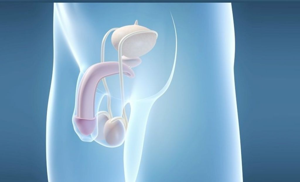 L'implantation d'une prothèse est une méthode chirurgicale d'agrandissement du pénis masculin