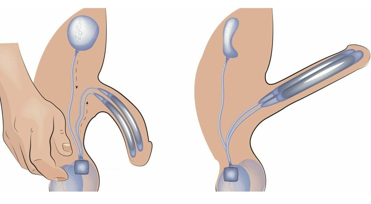 Prothèse pénienne pour l'agrandissement du pénis